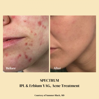 Tattoo and Scar Removal Spectrum Raleigh IPL and Erbium YAG, Acne treatment before and after