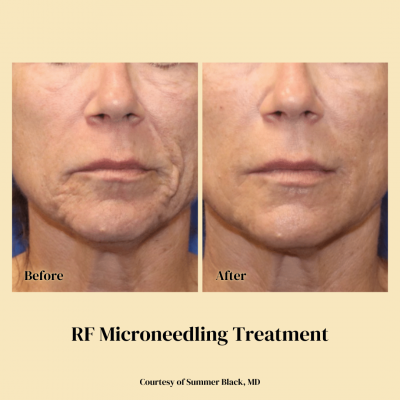 Tattoo and Scar Removal RF Microneedling treatment Raleigh before and after