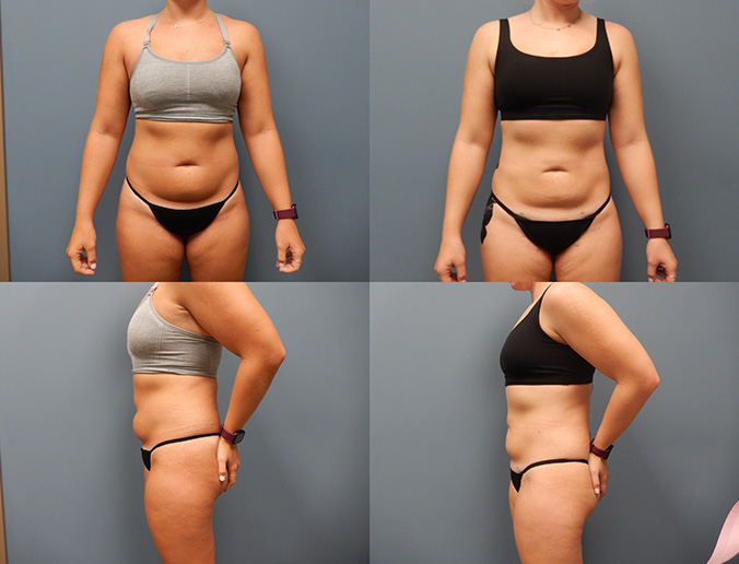 Abdominal Lipo Patient 186