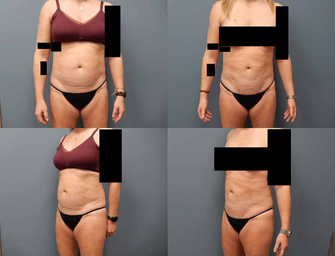 Abdominal Lipo Patient 187
