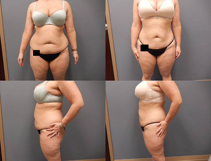 Abdominal Liposuction Raleigh Patient 127