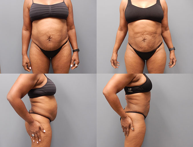 Abdominal Liposuction Raleigh Patient 131