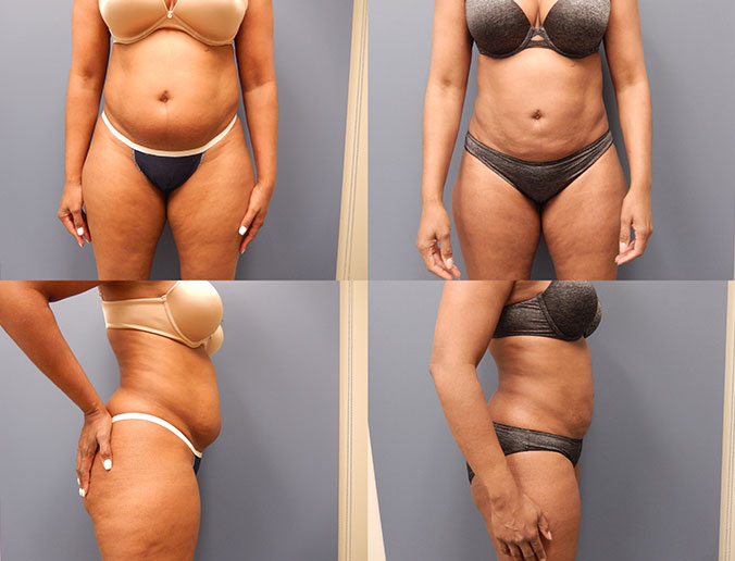 Abdominal Liposuction Raleigh patient 107