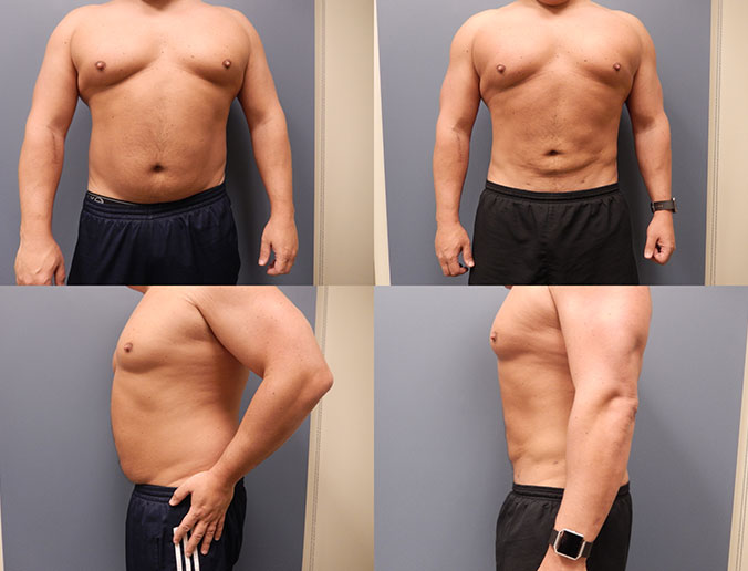 Abdominal Liposuction Raleigh patient 110