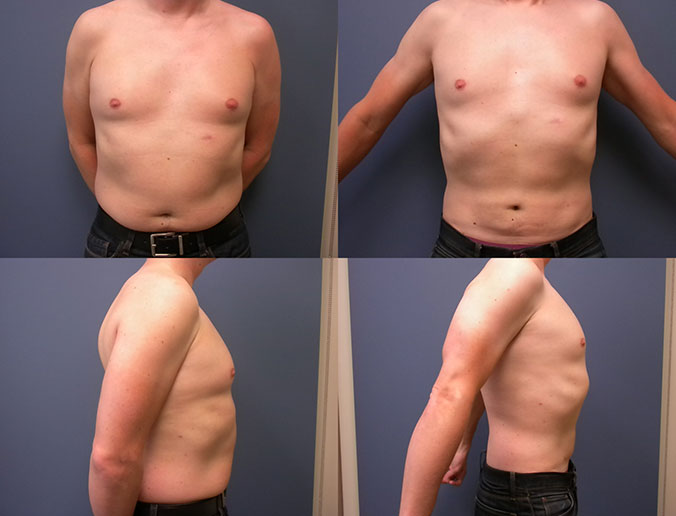 Abdominal Liposuction Raleigh patient 30 3