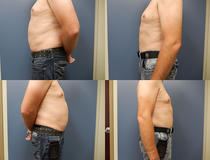 Abdominal Liposuction Raleigh patient 5