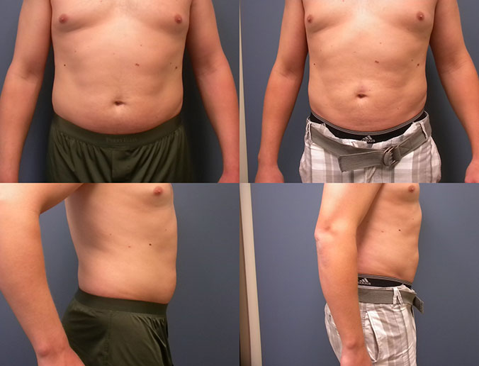 Abdominal Liposuction Raleigh patient 75