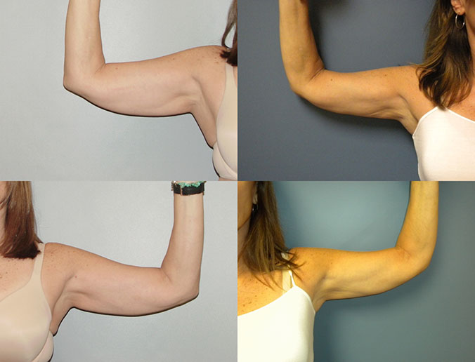 Arm Liposuction Raleigh Patient 1 2