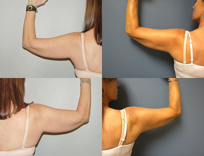 Arm Liposuction Raleigh Patient 1