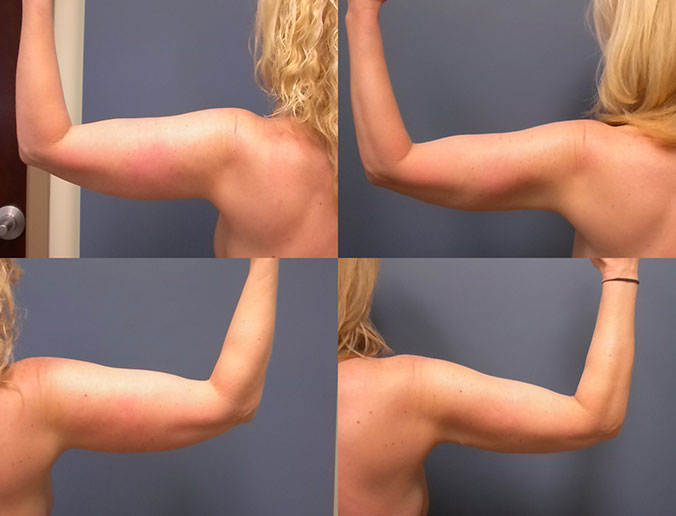 Arm Liposuction Raleigh Patient 11 B
