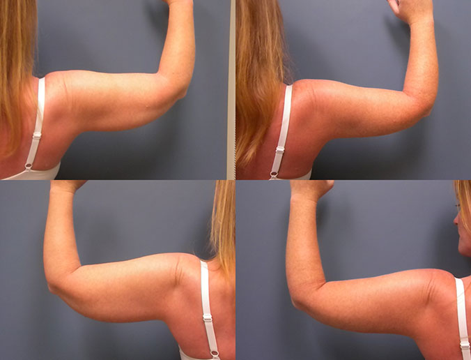 Arm Liposuction Raleigh Patient 12 1mo