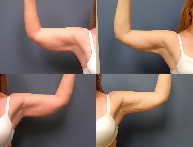 Arm Liposuction Raleigh Patient 12