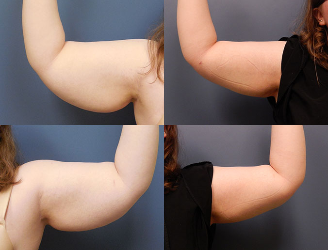 Arm Liposuction Raleigh Patient 13 front