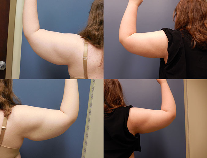 Arm Liposuction Raleigh Patient 13