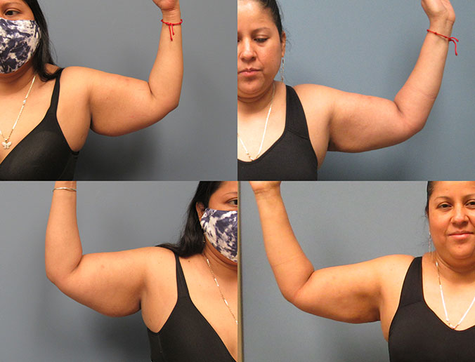 Arm Liposuction Raleigh Patient 24 1month