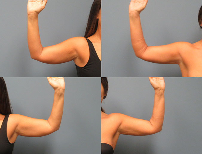 Arm Liposuction Raleigh Patient 26 1 month front