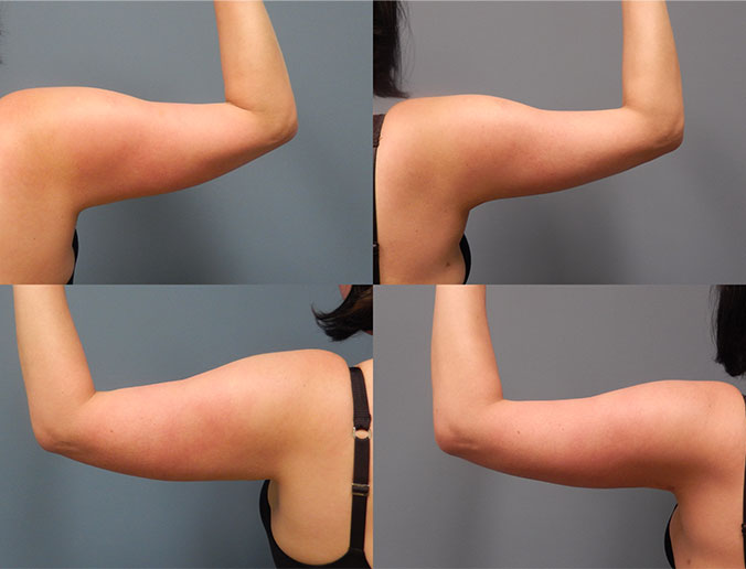 Arm Liposuction Raleigh Patient 28 2