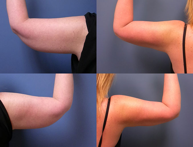 Arm Liposuction Raleigh Patient 4 1