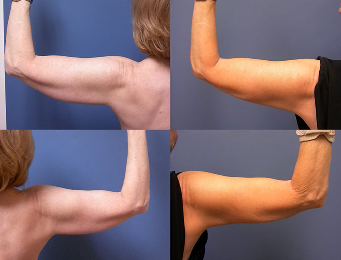 Arm Liposuction Raleigh Patient 8 1
