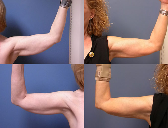Arm Liposuction Raleigh Patient 8 2
