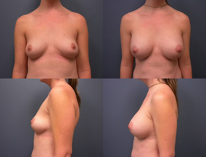 Breast Augmentation Raleigh Patient 15 S 340