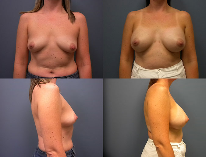 Breast Augmentation Raleigh Patient 17 330S