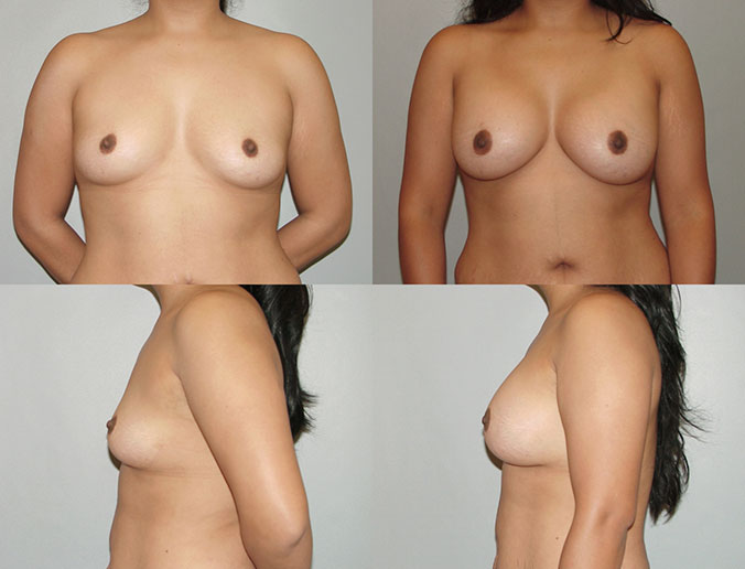 Breast Augmentation Raleigh Patient 3 S 375