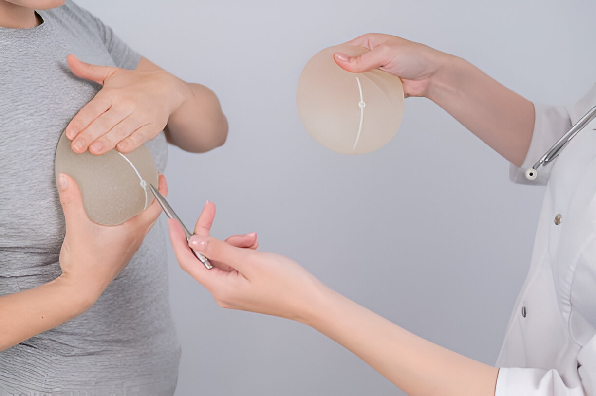 Breast Implant Exchange Diehl Plastic Surgery