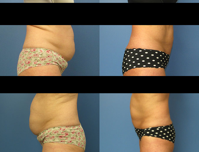 CoolSculpting Raleigh EH 1