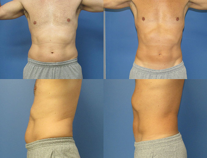 CoolSculpting Raleigh JP Abs & Flanks CSCT