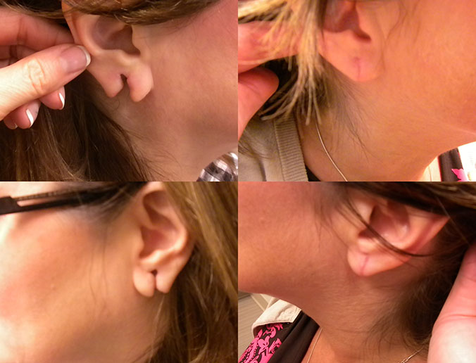 Earlobe Repair Raleigh Patient 1