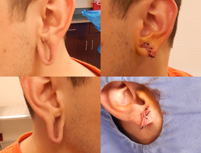 Earlobe Repair Raleigh Patient 10