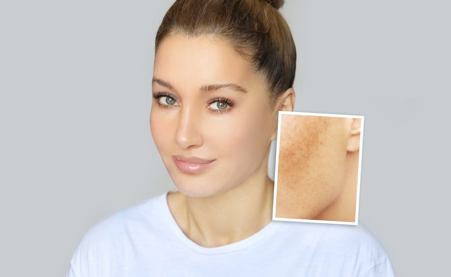 Hyperpigmentation Raleigh