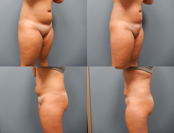 Mons Lipo Patient 141 1mo