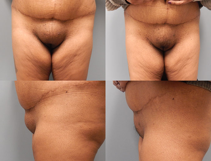 Mons Liposuction Raleigh Patient 131 1