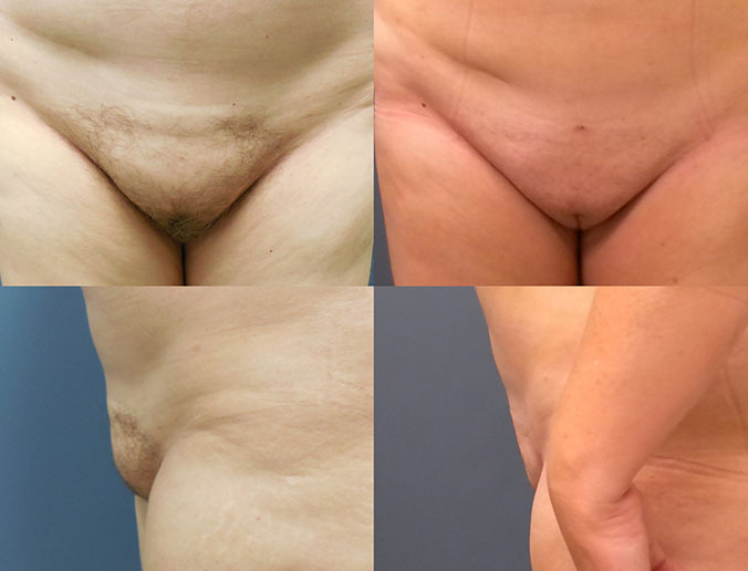 Mons Liposuction Raleigh Patient 2