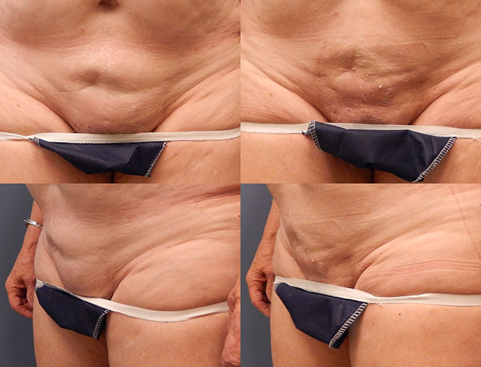 Mons Liposuction Raleigh Patient 3