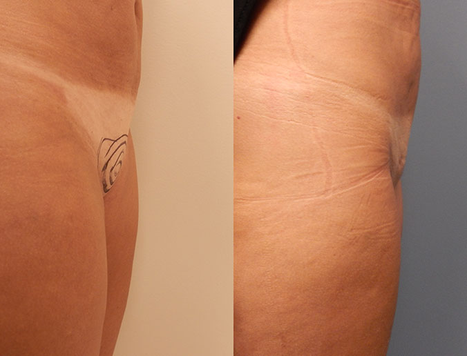 Mons Liposuction Raleigh Patient 4 1
