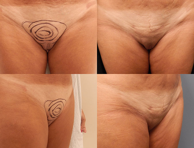 Mons Liposuction Raleigh Patient 4