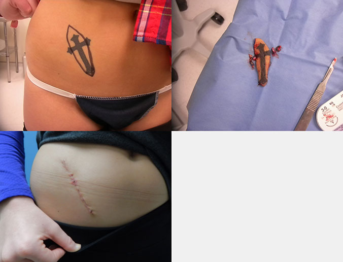 Tattoo Removal Raleigh Patient 14