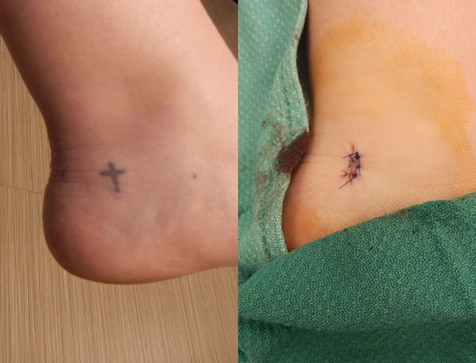 Tattoo Removal Raleigh Patient 21