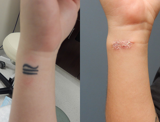 Tattoo Removal Raleigh Patient 27