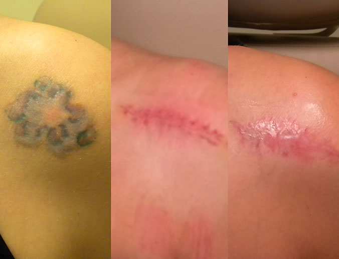 Tattoo Removal Raleigh Patient 6 1