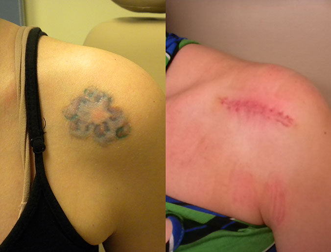 Tattoo Removal Raleigh Patient 6