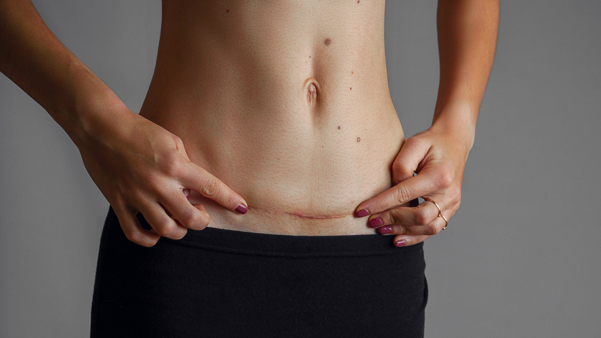 Tattoo and Scar Removal Raleigh
