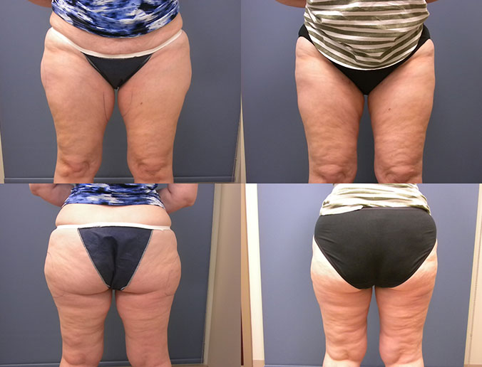Thigh Liposuction Raleigh Patient 14