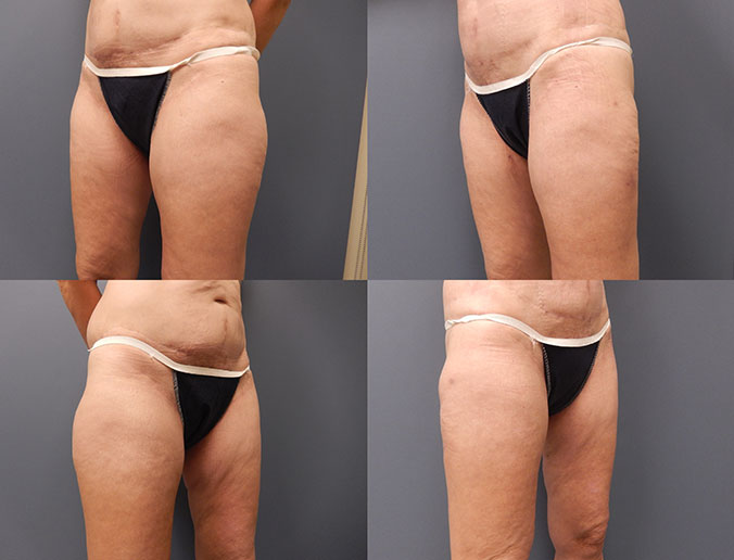 Thigh Liposuction Raleigh Patient 18 1 month