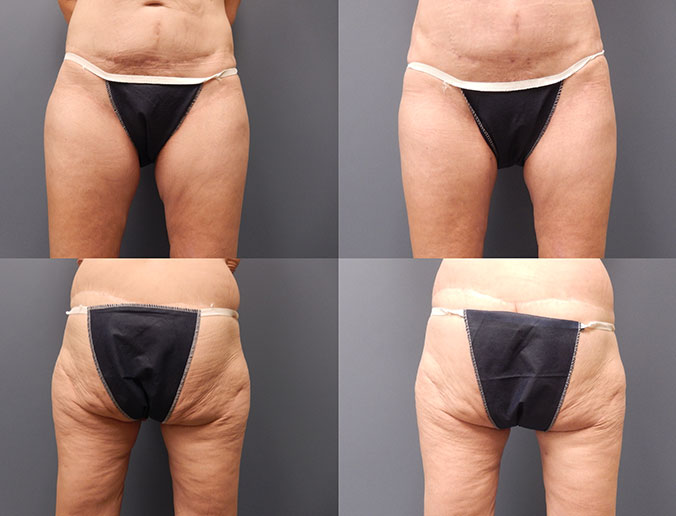 Thigh Liposuction Raleigh Patient 18