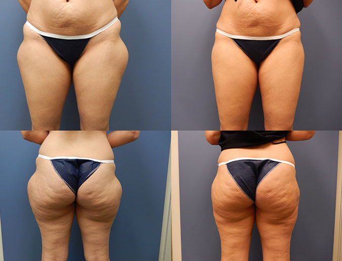 Thigh Liposuction Raleigh Patient 26