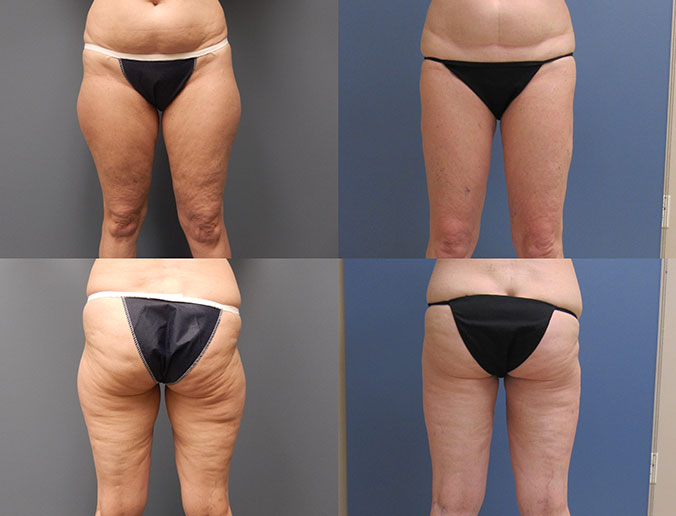 Thigh Liposuction Raleigh Patient 40